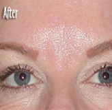 Patient # 84332 After Photo # 4